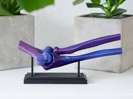 Công nghệ in 3D giúp người đàn ông phục hồi khuỷu tay bị biến dạng